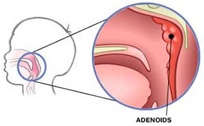 adenoids