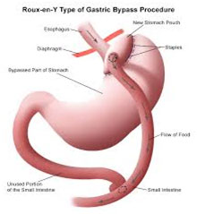 gastric bypass