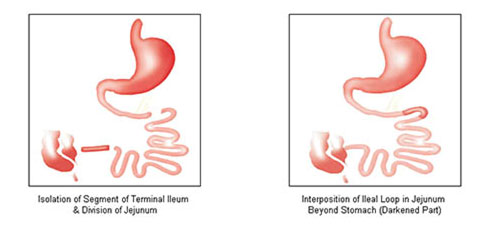 Ileal Transposition